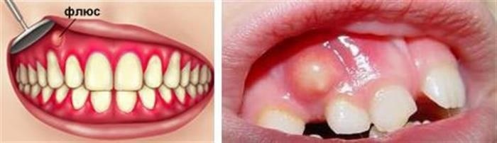 Особенности удаления зубов мудрости