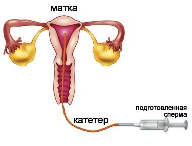 Существуют и другие методы диагностики бесплодия